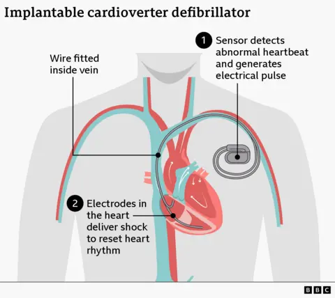 BBC infographic for an implantable cardioverter defibrillator (ICD) showing a simplified human torso with the heart and major veins. A small implanted device sits in the chest with a wire running through a vein into the heart. Labels explain that a sensor detects an abnormal heartbeat and generates an electrical pulse, and then electrodes in the heart deliver a shock to reset heart rhythm.