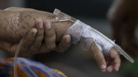 Getty Images A child's arm covered in blisters, with tape around its hand and a cannula, held up by an adult's hand
