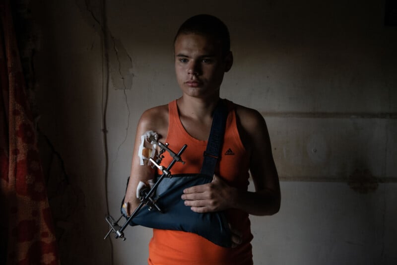 A boy in an orange tank top stands indoors with his injured arm in a sling, held by a metal external fixator, looking serious in dim lighting.