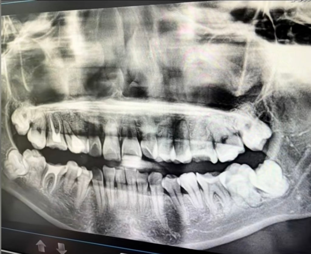 An X-ray of Wu’s mouth shows the damage that was done to her during the procedure. Photo: Douyin