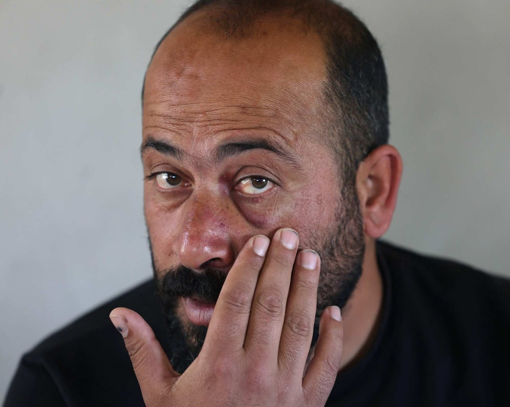 Palestinian Oscar winner Hamdan Ballal shows his injuries after his attack. Photo: AFP