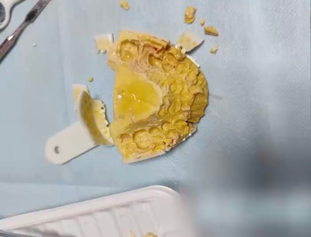 The broken home-made mould after doctors removed it from the woman’s mouth. Photo: ifeng