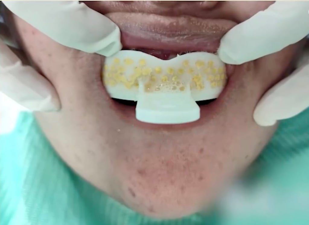 A close up photograph shows the wrongly applied mould stuck in the woman’s mouth Photo: ifeng