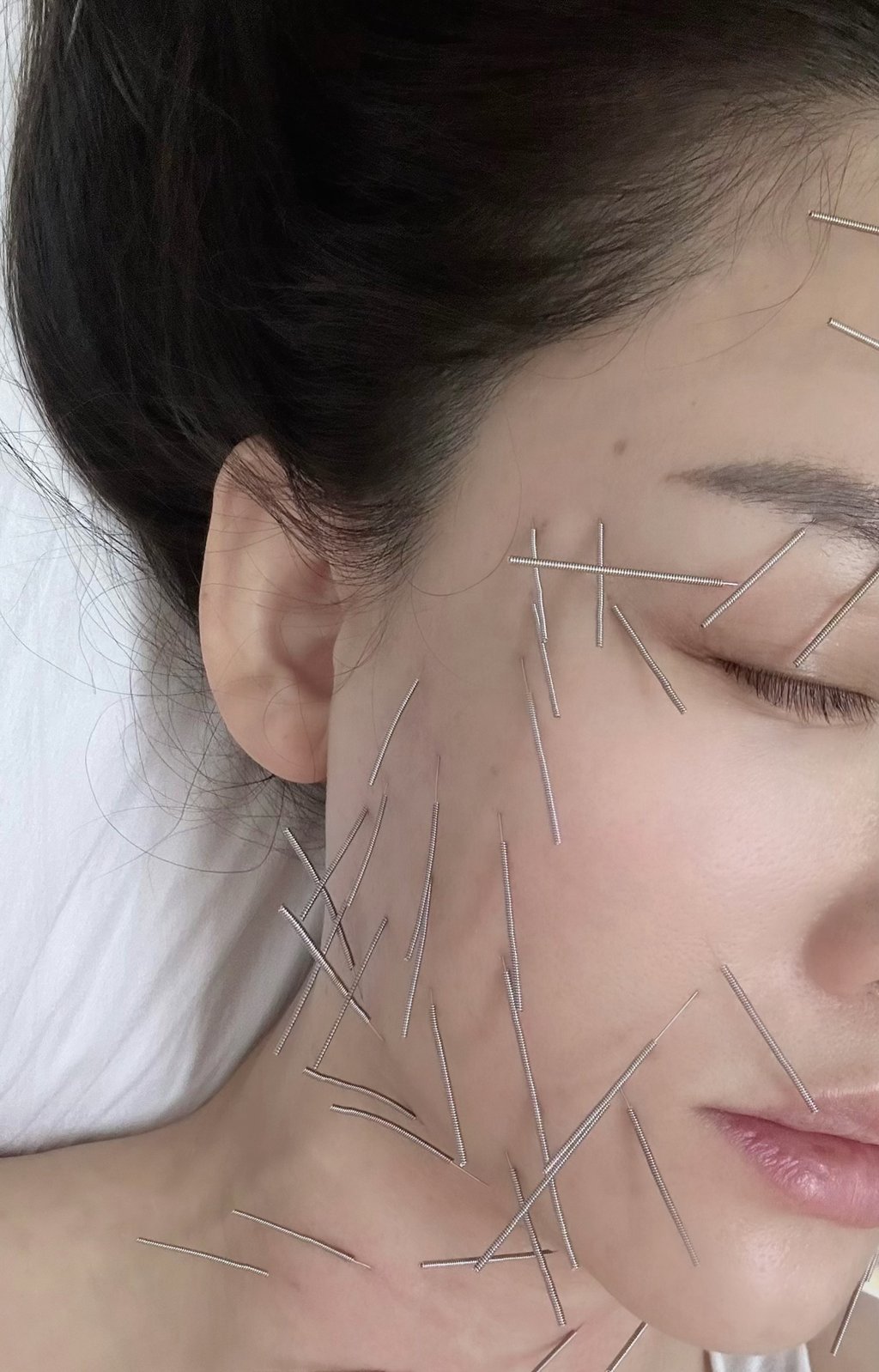 Pain in the neck: Joe Chen Chiao-en had scores of needles pushed into her skin. Photo: Handout