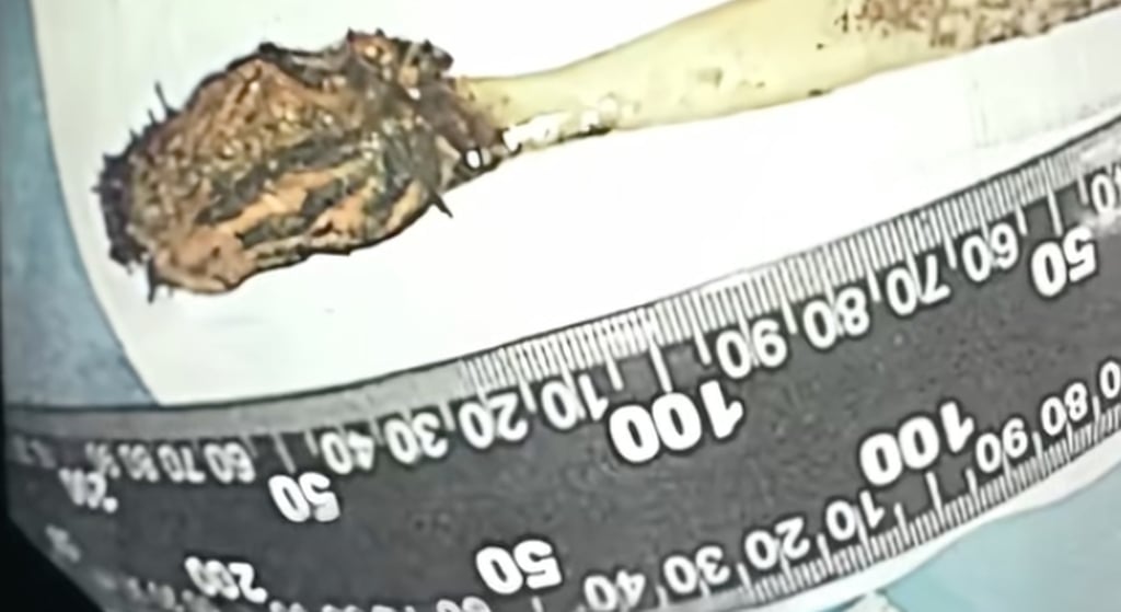 Despite the toothbrush being inside his body for many years, the man said he had not felt anything untoward until recently. Photo: handout