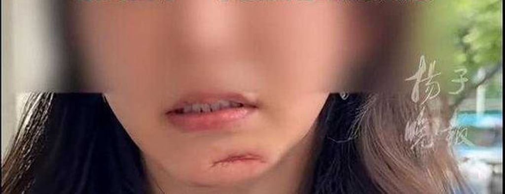 According to doctors, Ding’s unsightly scar resulted from “mistaken and dangerous” advice she was given. Photo: Douyin