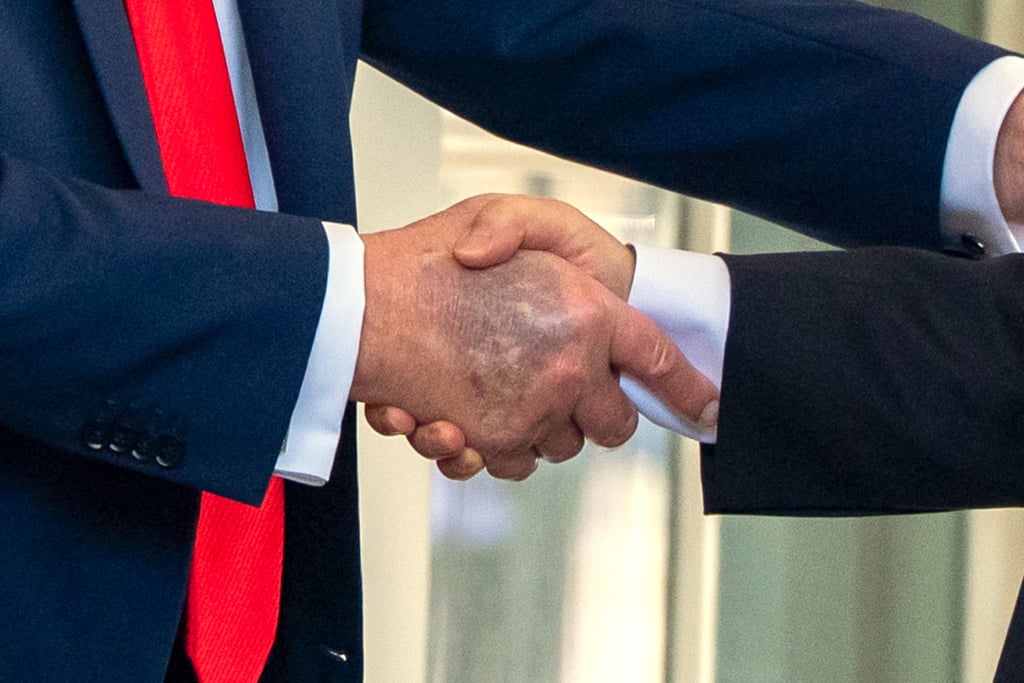 US President Donald Trump’s bruised hand on August 25. Photo: AP