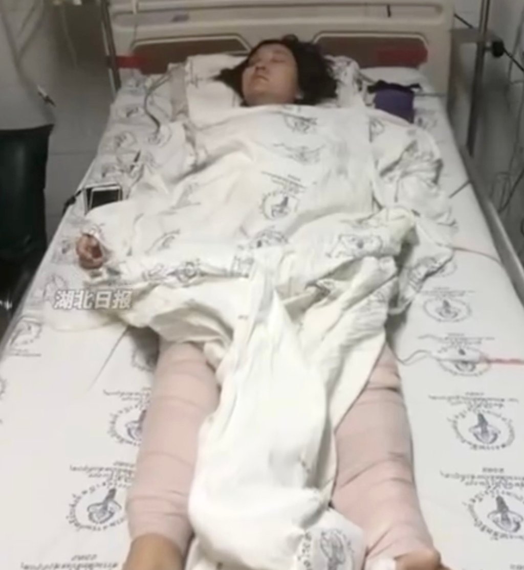 At that time, Wang, above, was pregnant and had endured 17 bone fractures, multiple surgeries, over 100 steel pins, and 200 stitches. Photo: Handout