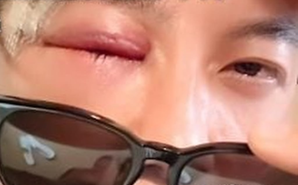 Zhao Honggang shows off the injuries he suffered in the slapping competition. Photo: RedNote