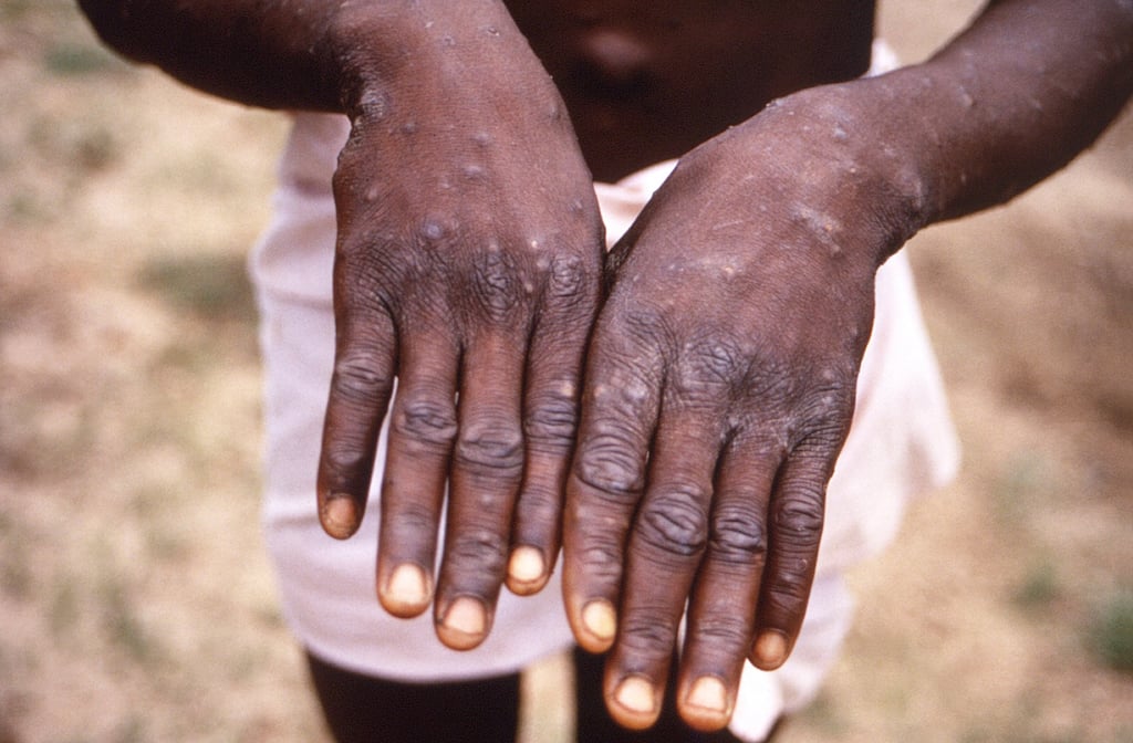 Mpox is a viral infection related to smallpox, causing fever, body aches and distinct skin lesions, and can be deadly. Photo: AP