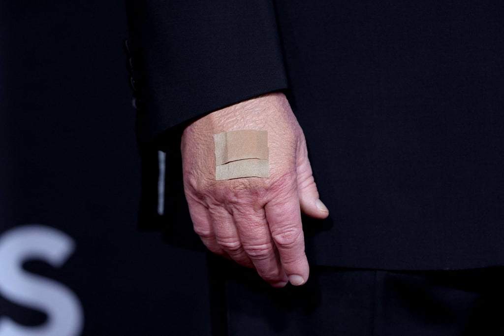 US President Donald Trump’s bandaged hand on December 7. Photo: Reuters