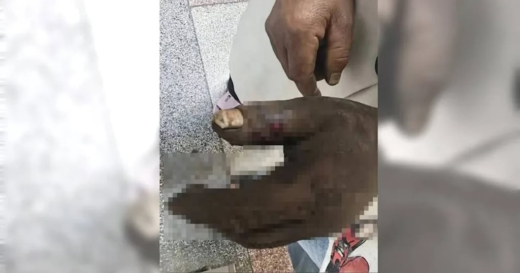 The husband’s wound quickly became swollen and darkened, leaving him feeling dizzy and weak. Photo: Handout