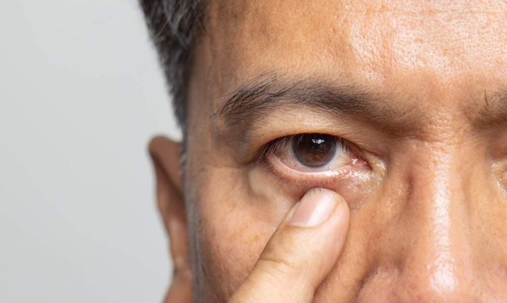 Some elderly locals in China believe that sticking a strip of white paper onto the eyelid halts the twitching. Photo: Shutterstock
