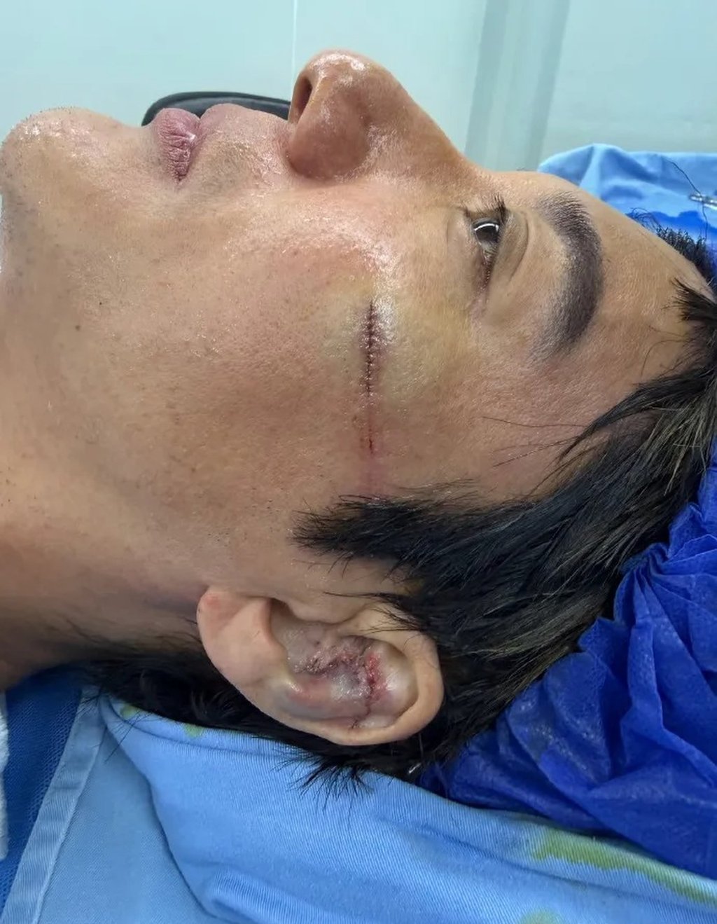 Showing off his battle scars, the singer posted images of his wounds, revealing he required 27 stitches to his ear and 12 to his face. Photo: Handout