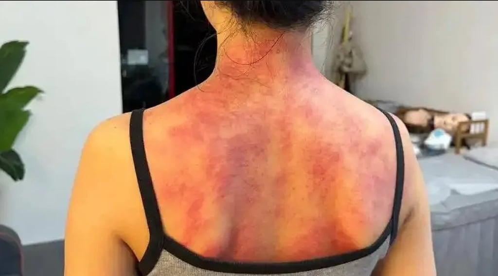 In traditional Chinese medicine, “damp-heat” is one of the most common internal imbalances identified as the cause of sudden or persistent red, itchy patches on the skin, especially on the back. Photo: QQ.com