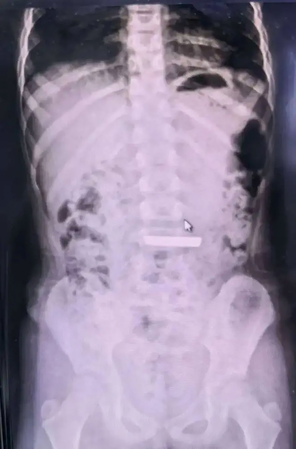 The girl was brought to the hospital after swallowing a small gold bar six hours prior and an X-ray revealed that the gold bar remained lodged in her stomach. Photo: QQ.com