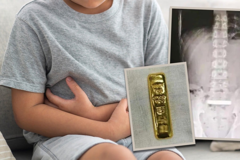 A Chinese boy’s distended abdomen prompted a visit to the doctor, who found that he had ingested a gold bar. Photo: SCMP composite/Shutterstock/Douyin
