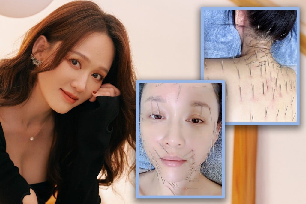 A Taiwanese actress has shocked social media after she posted photos of her face and body pinned with fine needles during an acupuncture treatment. Photo: SCMP composite/Weibo