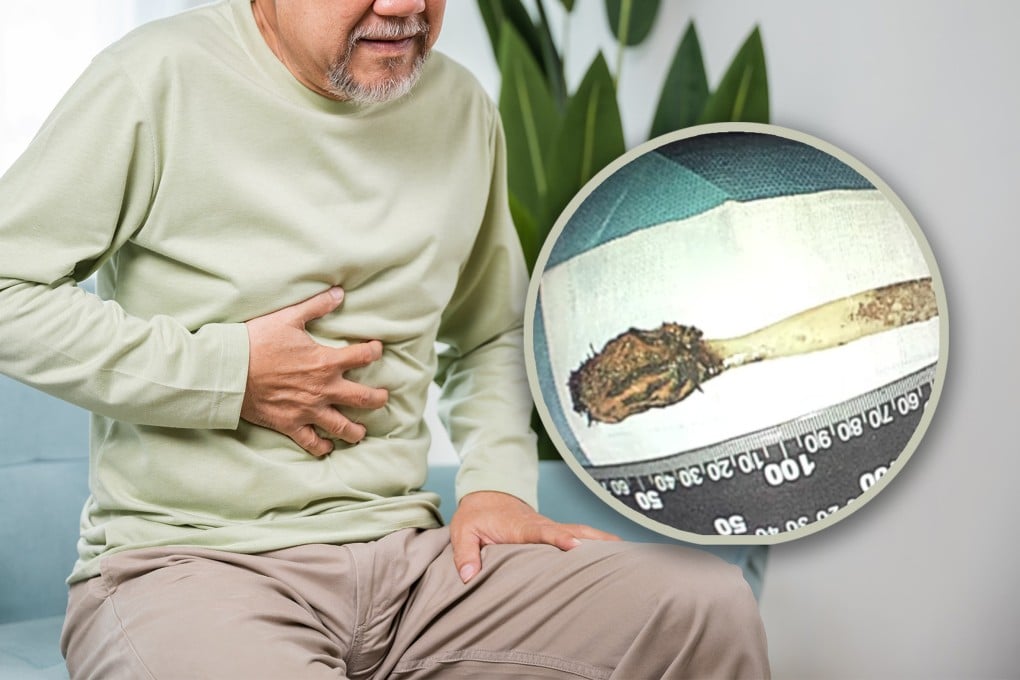 A 64-year-old man in China who swallowed a toothbrush when he was 12 years old has finally had it removed from his stomach in an 80-minute surgical procedure. Photo: SCMP composite/Shutterstock/Douyin