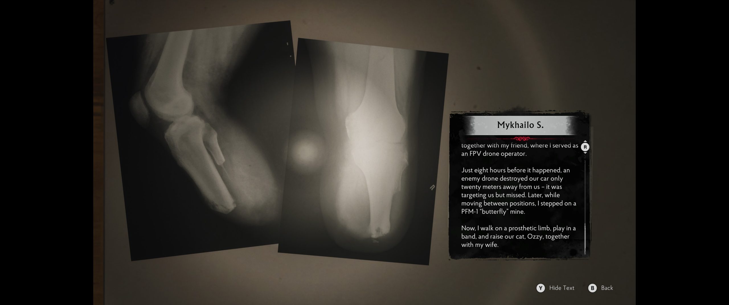 Two X-ray images are displayed alongside a narrative text titled 'Mykhailo S.' describing a personal experience with a drone attack and prosthetic usage, with game control options shown at the bottom.
